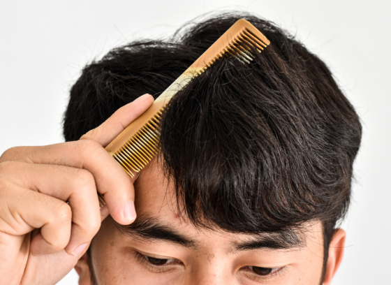 5 mẹo điều trị rụng tóc nhiều bằng phương pháp tự nhiên