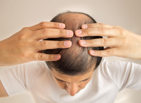 Rụng tóc do bệnh lý - triệu chứng và nguyên nhân